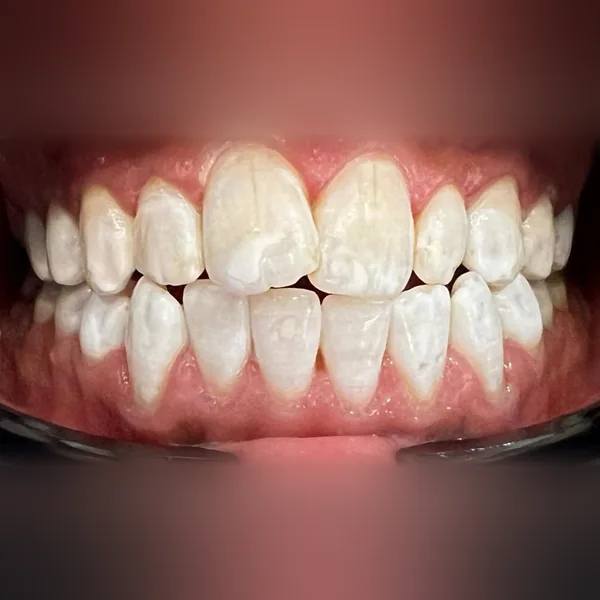 Après : dents éclaircies sur toute l'arcade