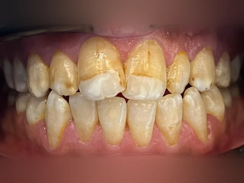 Avant : dents jaunies avec des taches brunes