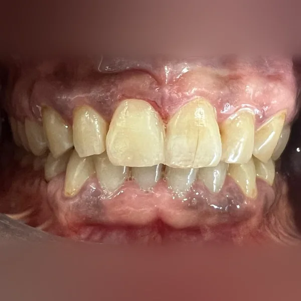 Après : incisive revenue à la teinte des dents voisines