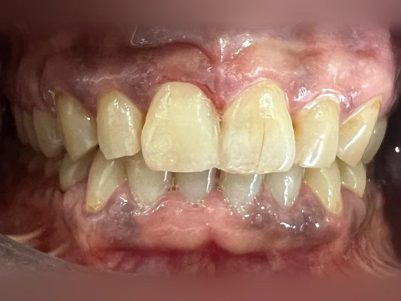 Après : incisive revenue à la teinte des dents voisines
