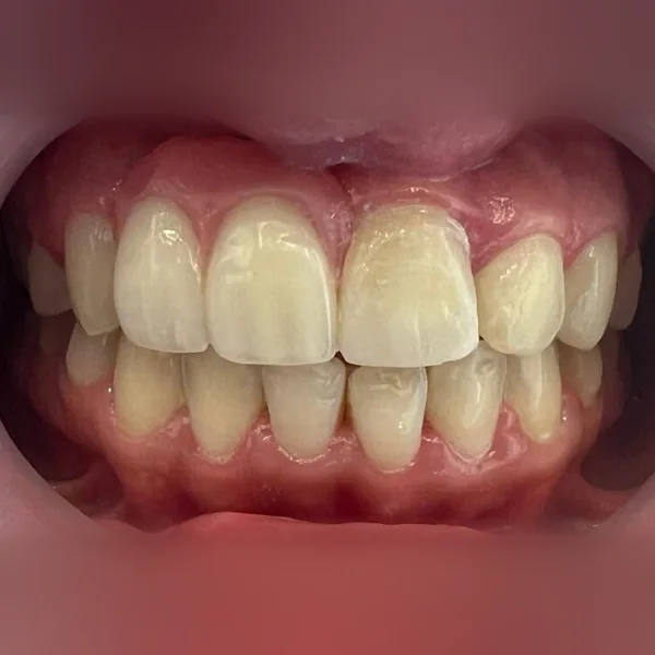 Après : facettes sur les dents du haut, teinte claire et forme régulière