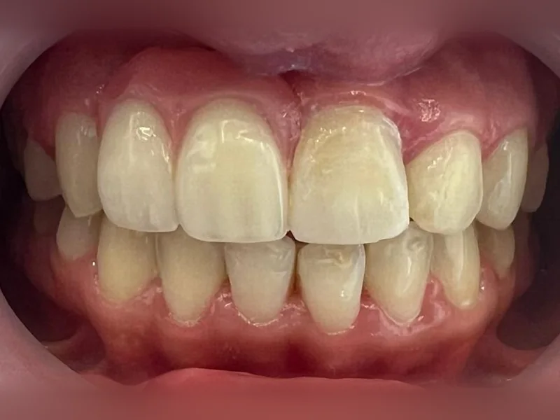 Après : facettes sur les dents du haut, teinte claire et forme régulière