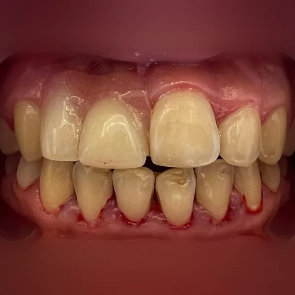 Avant : dents du haut jaunies, de formes inégales