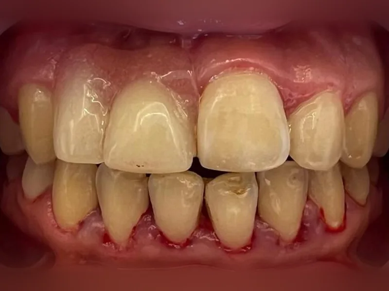 Avant : dents du haut jaunies, de formes inégales