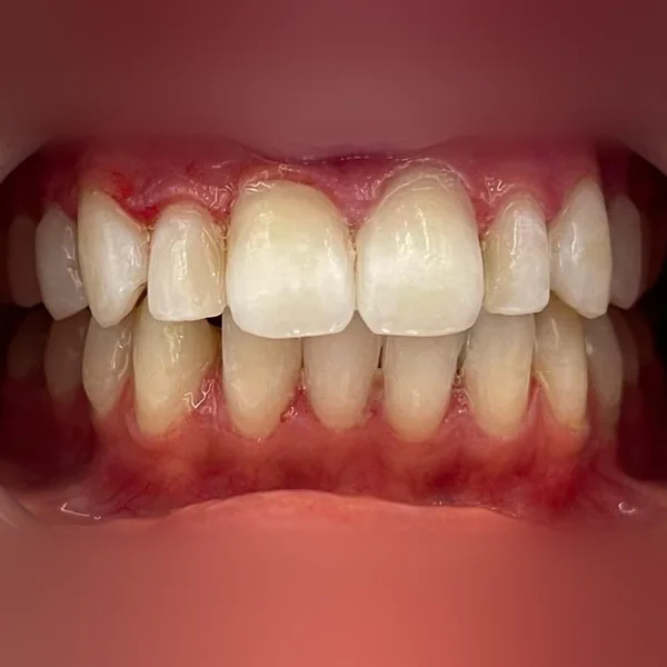 Après : facettes sur les dents du haut, teinte claire et homogène