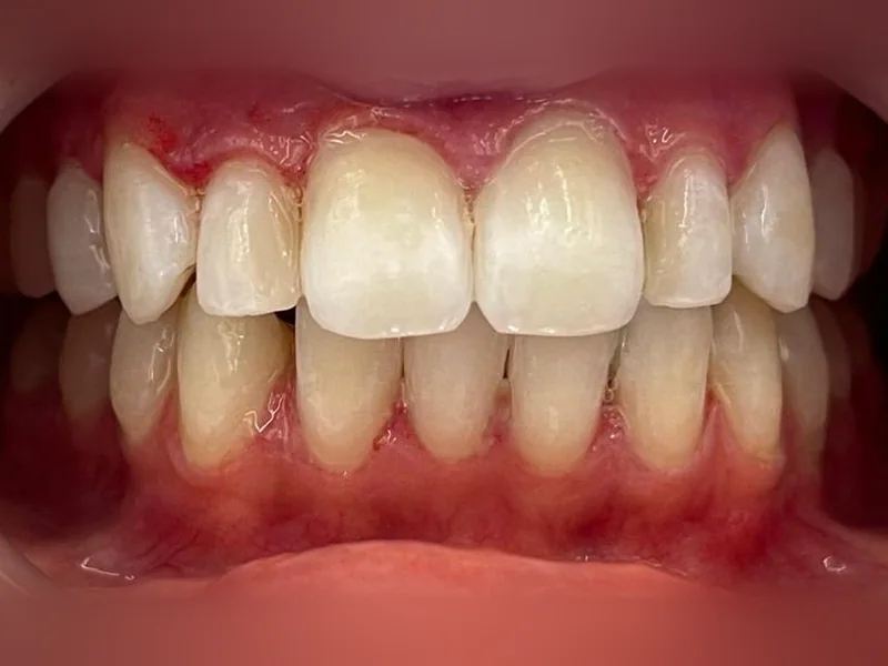Après : facettes sur les dents du haut, teinte claire et homogène