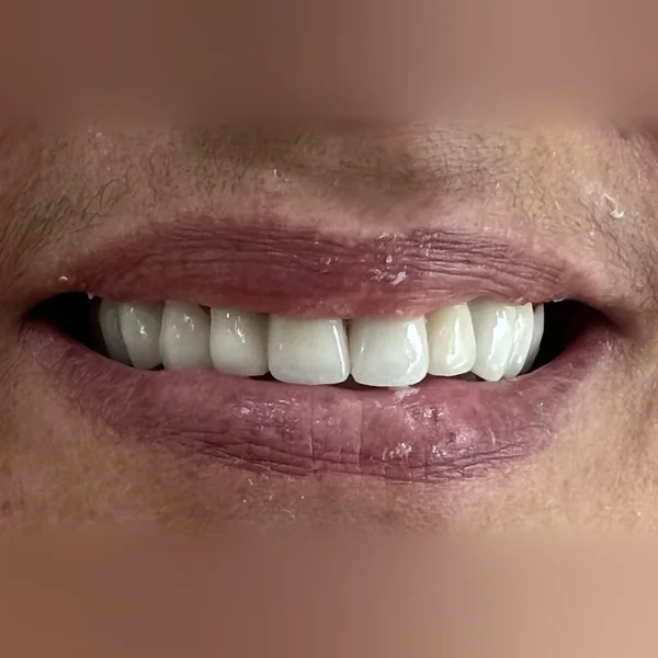 Après : sourire refait en entier, sans espace visible