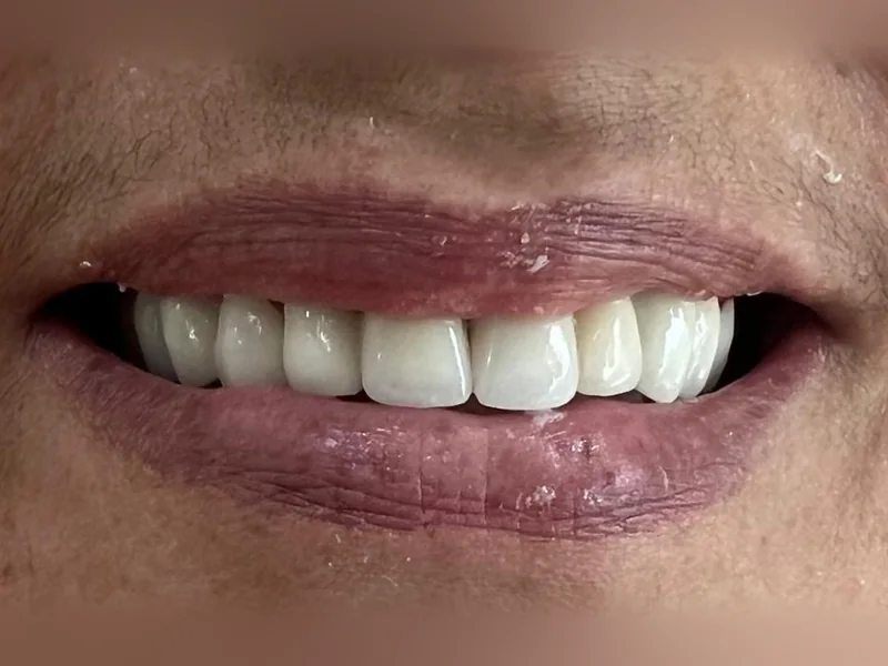 Après : sourire refait en entier, sans espace visible