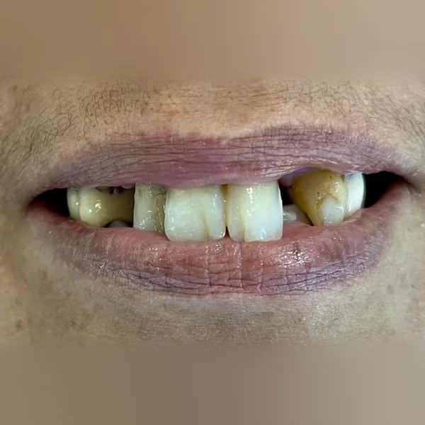 Avant : sourire avec des dents manquantes, usées et jaunies