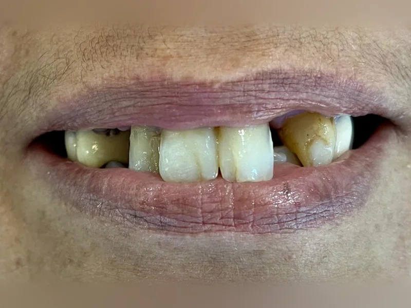 Avant : sourire avec des dents manquantes, usées et jaunies