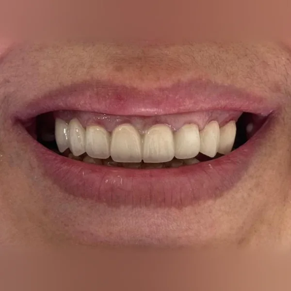 Après : dents du sourire refaites, teinte et forme régulières
