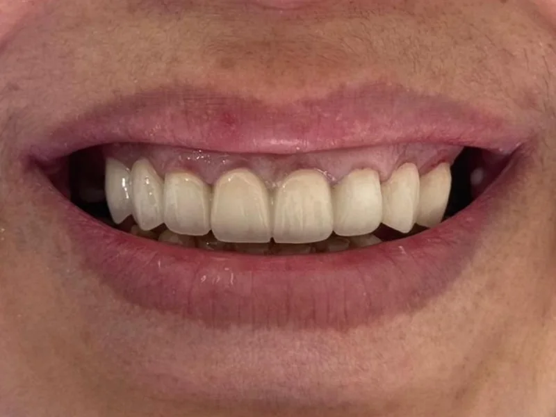 Après : dents du sourire refaites, teinte et forme régulières