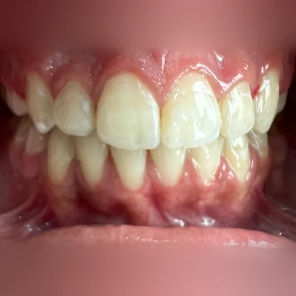 Après : dents alignées après traitement orthodontique
