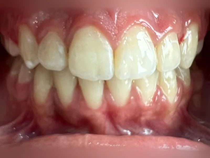 Après : dents alignées après traitement orthodontique