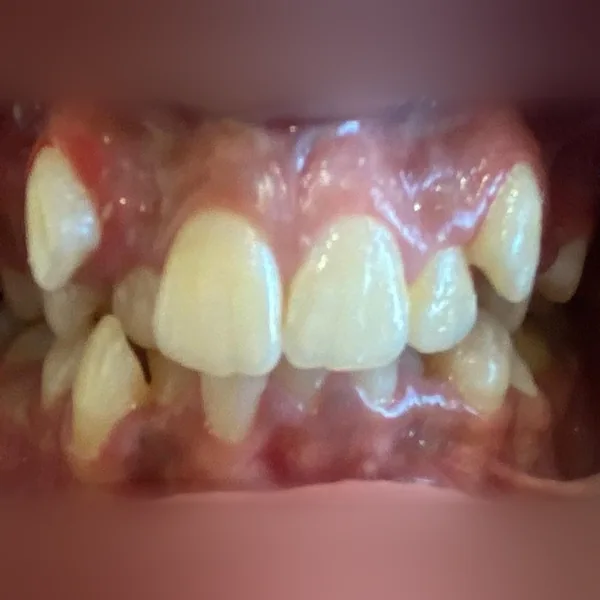 Avant : canines hors de l'arcade et dents chevauchées