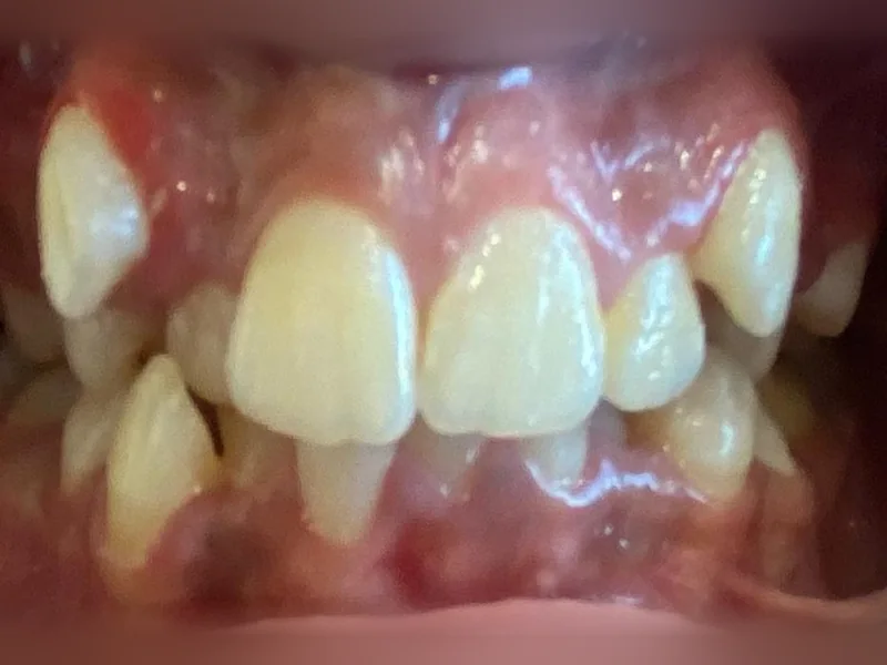 Avant : canines hors de l'arcade et dents chevauchées